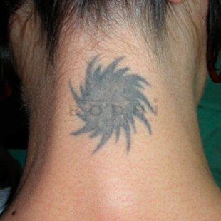 Eliminacion de tatuajes en Alicante