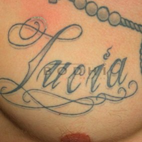 Eliminacion de tatuajes en Alicante