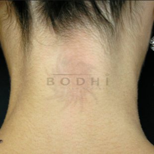 Eliminacion de tatuajes en Alicante