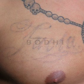 Eliminacion de tatuajes en Alicante