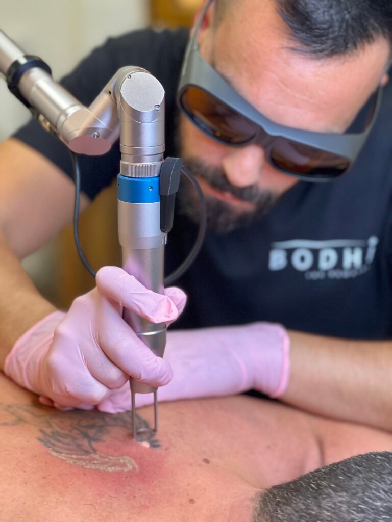 Eliminación de tatuajes en Alicante