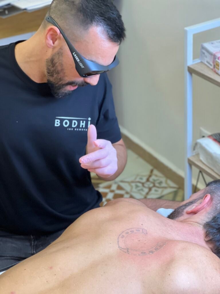 Eliminacion de tatuajes