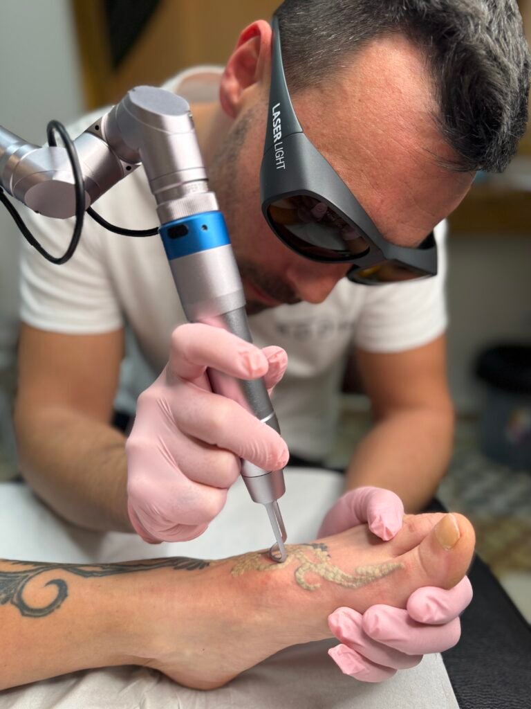 Eliminar un tatuaje