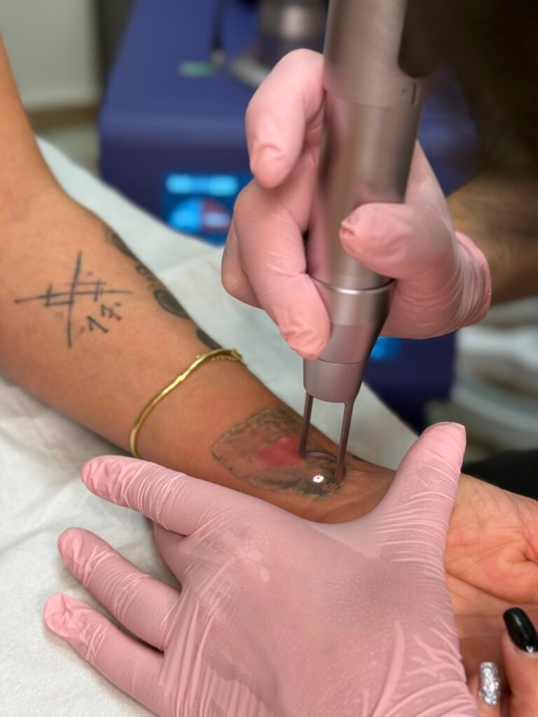 Eliminación de tatuajes