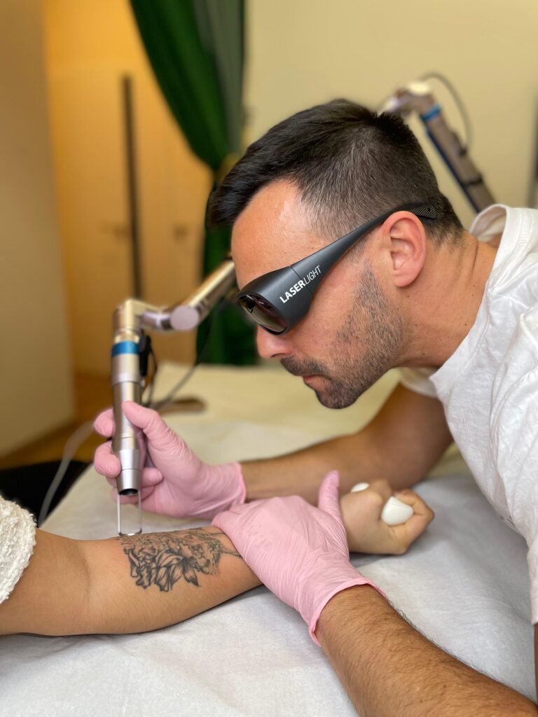 Eliminación de tatuajes en Alicante