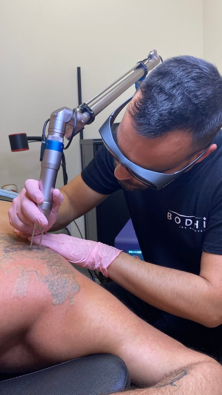 Eliminación de tatuajes en verano