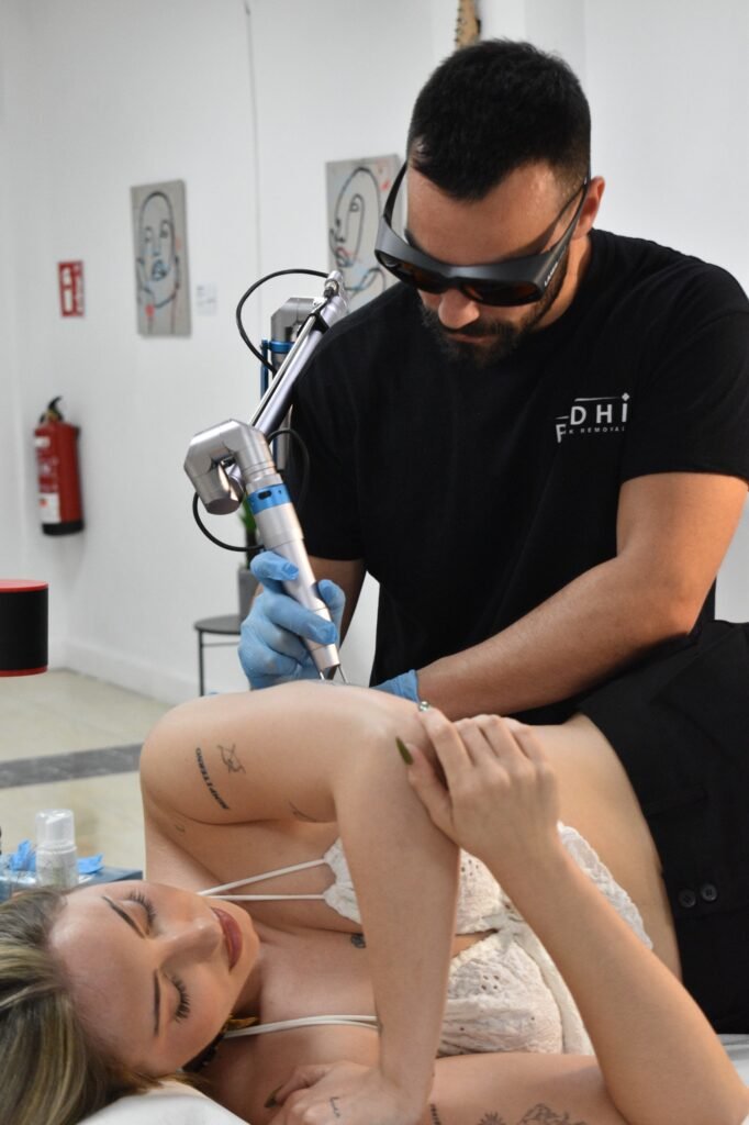 Cuidados post sesion de eliminación de tatuajes