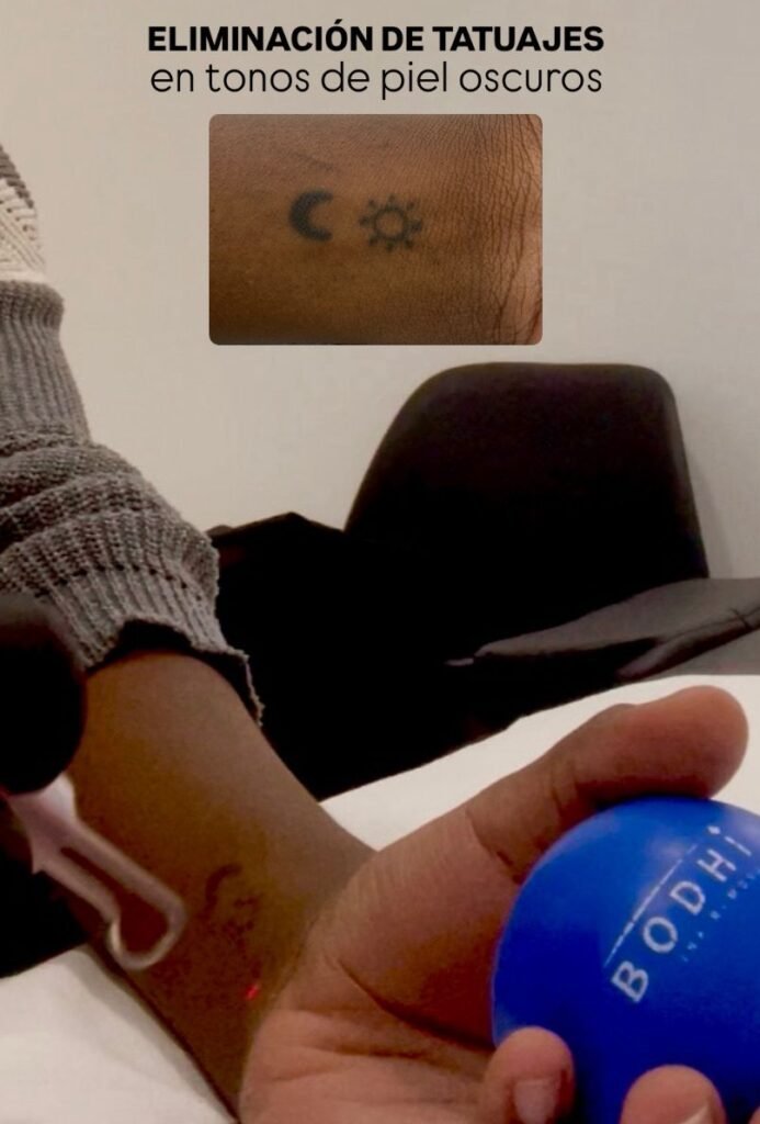 Eliminación de tatuajes con láser en pieles oscuras con INK Hunter Master Pro