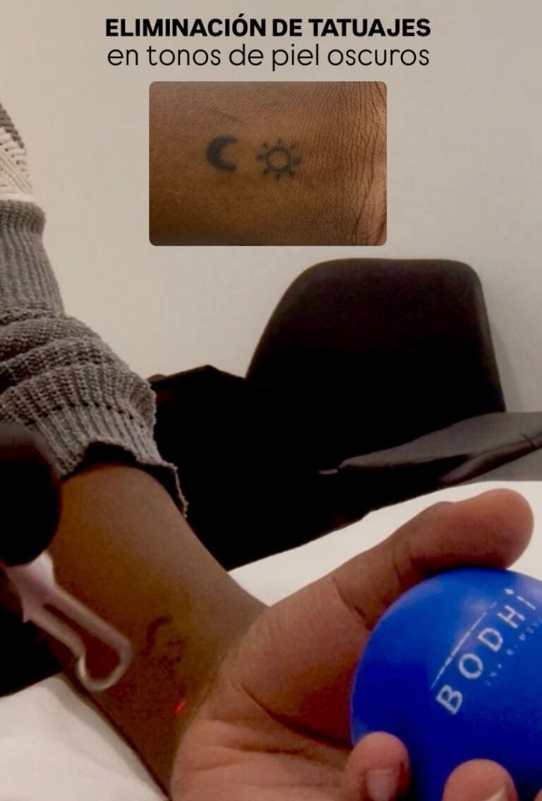 Eliminación de tatuajes con láser en pieles oscuras con INK Hunter Master Pro